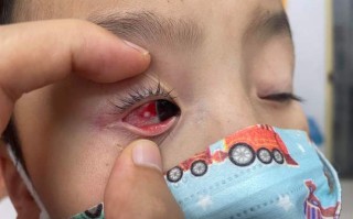 儿童肺部吸入异物后，会出现哪些容易被忽视的呼吸系统症状？