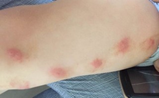 儿童海鲜过敏症状图片有哪些？如何辨别严重过敏反应？