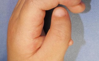 儿童拇指弯曲不能伸直，是先天畸形还是后天损伤？该如何处理？