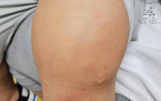 儿童髋关节滑膜炎有哪些典型症状？家长该如何早期识别与应对？