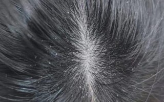 孕期头皮屑突然增多，是激素变化还是营养缺乏在作祟？