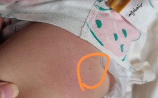 儿童大腿外侧接种图片