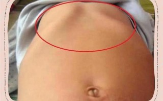 儿童左胸骨头突出是正常生理现象还是疾病征兆？附图片对比解析。