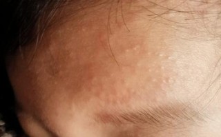 新生儿脑门上长小疙瘩是什么原因？需要担心吗？