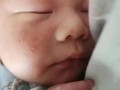 新生儿脸上有小红点点