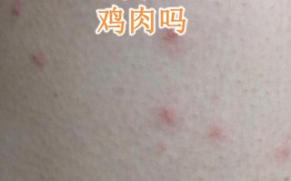 儿童出水痘期间饮食该注意什么？哪些食物能促进恢复？