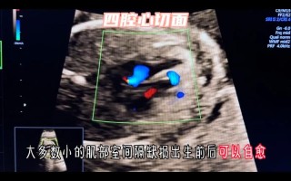 新生儿室间隔缺损肌部