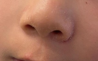 新生儿鼻翼两侧有黄痂