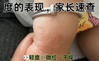 儿童霉菌过敏注意什么