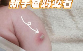 新生儿卡介苗化脓破了咋处理？