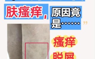 孕期腿部瘙痒是缺钙还是胆汁淤积？需要警惕哪些危险信号？