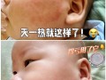 新生儿脸上红斑是湿疹还是血管瘤？需要治疗吗？