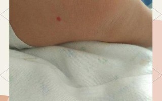 新生儿腿上长血管瘤，家长该注意什么？会自行消退吗？需要治疗吗？