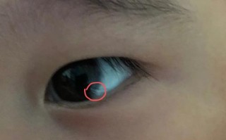 新生儿黑眼珠边缺一块