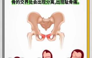 孕期耻骨疼是正常生理反应还是疾病信号？原因有哪些，如何缓解？