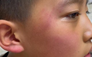 新生儿颜面部挤压淤青究竟是如何形成的？对宝宝健康会有哪些潜在影响？