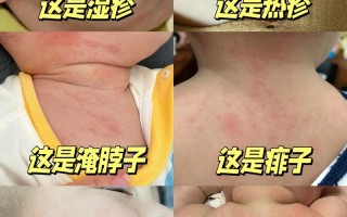 新生儿常见皮肤病配图