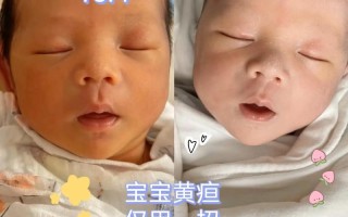 新生儿第三天黄疸18mg/dL需要立即干预吗？会对宝宝脑部发育有影响吗？