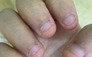 儿童咬指甲导致皮肤破损的图片是否真实存在？这些图片的拍摄与传播是否涉及隐私和伦理问题？