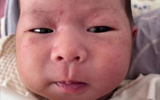 新生儿痤究竟能不能涂面霜？哪种面霜才安全有效？
