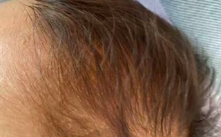 新生儿出现黄头发是营养不良还是正常生理现象？