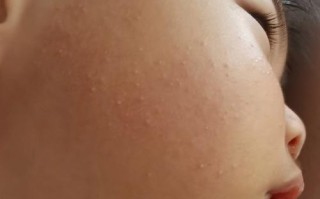 新生儿脸上小红疙瘩是啥原因？