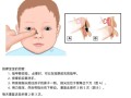 新生儿泪腺炎按摩视频操作手法是否正确？需注意哪些风险事项？