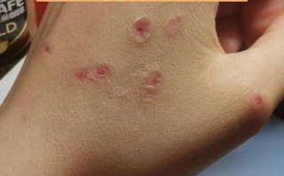 儿童扁平疣的最佳治疗方法有哪些？如何选择安全有效的治疗方式？