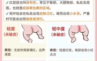 新生儿如何预防红屁屁