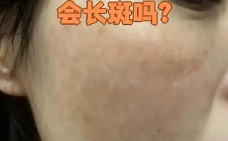 怀孕期间如何不长雀斑