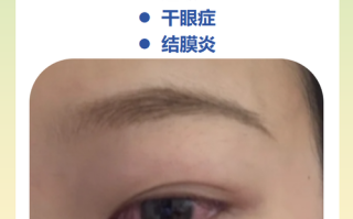 儿童眼睛周围红肿痒怎么办