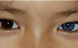 新生儿黑眼球发灰是正常现象吗？需要警惕哪些眼部问题？