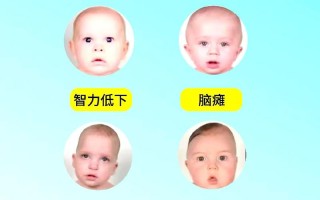 新生儿脑密度低是否严重？会影响智力发育吗？