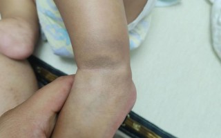 新生儿手上青斑会自行消退吗？需要干预治疗吗？