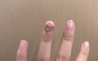 儿童指甲无故脱落是缺乏营养还是疾病信号？家长该如何应对？