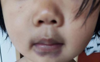 儿童嘴唇发黑是缺氧还是消化问题？需要警惕哪些疾病信号？