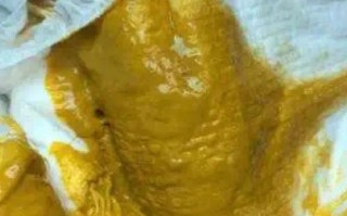 新生儿十天胎粪未排完，是正常生理延迟还是需要警惕的健康信号？