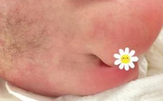 新生儿皮毛窦骶尾部该如何早期识别与干预？