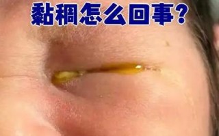 新生儿眼睛多黄眼屎是上火还是疾病信号？该如何正确处理？