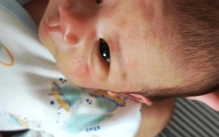 新生儿脸上有小红点白头是湿疹还是痤疮？该如何正确护理？