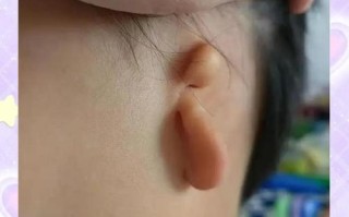 新生儿外耳廓软骨粘连如何正确干预与预防畸形发生？