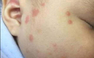 新生儿甲醛中毒有哪些典型表现？如何早期识别与科学应对？