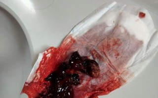 孕期宫颈息肉持续出血，会对胎儿造成不良影响吗？该如何有效处理？