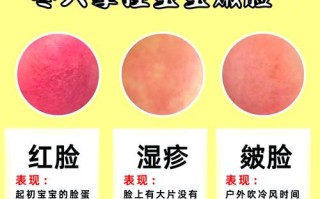 新生儿脸湿疹，最佳疗法是啥？