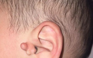 新生儿耳朵旁长出小附耳，是先天异常吗？需要手术切除吗？