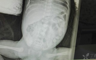 新生儿nec治愈后还会复发吗？复发风险与哪些因素相关？