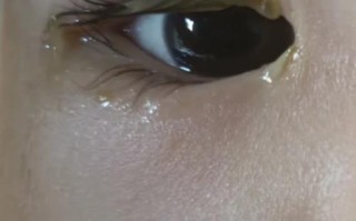 新生儿眼睛有白色眼屎是正常现象还是感染信号？需如何处理？