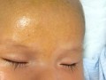 新生儿额头白色颗粒是正常现象吗？需要特别处理吗？