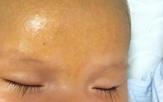 新生儿额头白色颗粒是正常现象吗？需要特别处理吗？