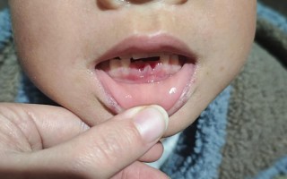 儿童换牙期恒牙未脱落就萌出，是何原因导致的？是否需要干预处理？